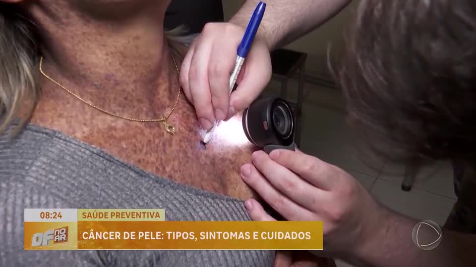 Especialistas alertam para riscos do melanoma com aumento da exposição ao sol no verão
