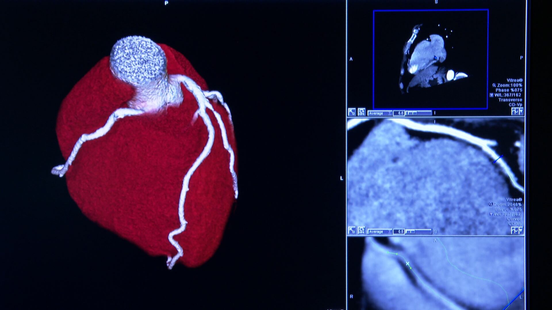 Nova tecnologia detecta placas de gordura em artérias