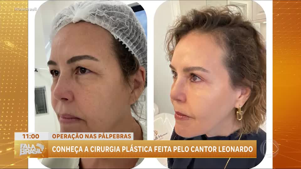 Blefaroplastia: cirurgia das pálpebras cresce em popularidade por estética e saúde