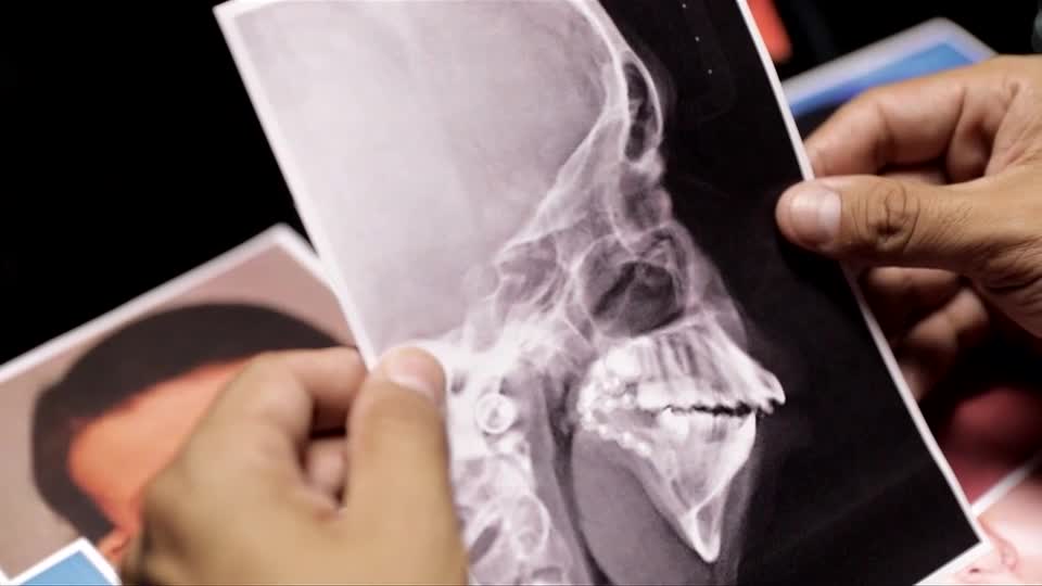 The Love School — Escola do Amor mostra os desafios no amor de um homem com síndrome de Pierre Robin