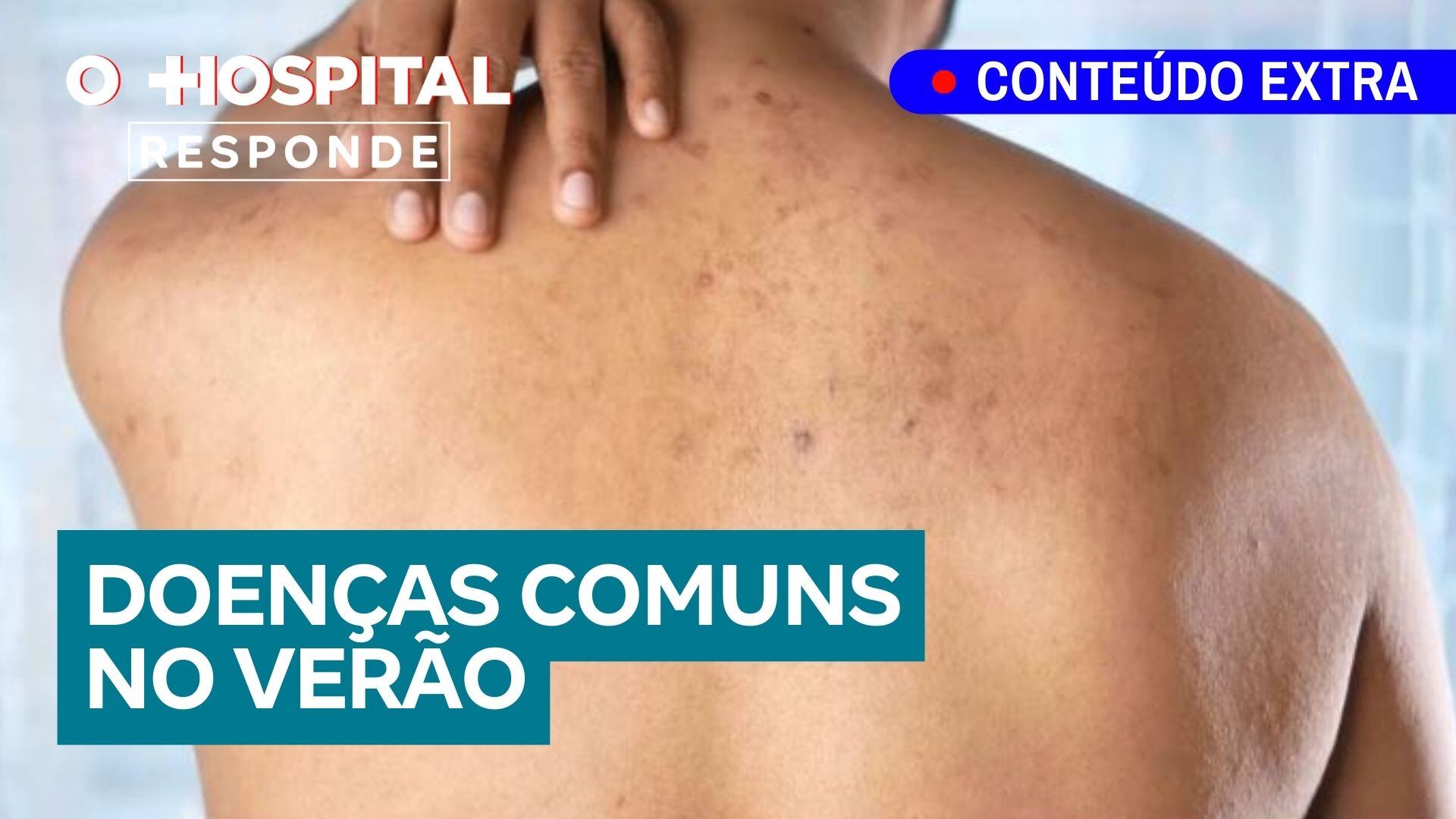 Verão e infecções de pele: saiba quais são as mais comuns e como se proteger | O Hospital Responde 