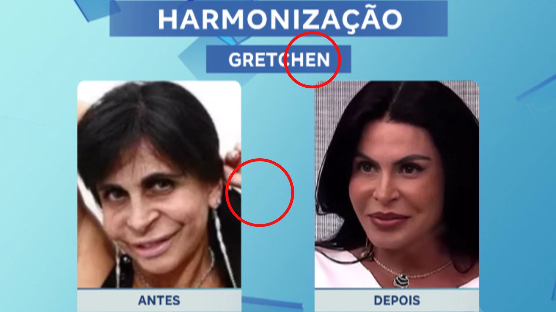 Veja o antes e depois de famosos que fizeram procedimentos estéticos