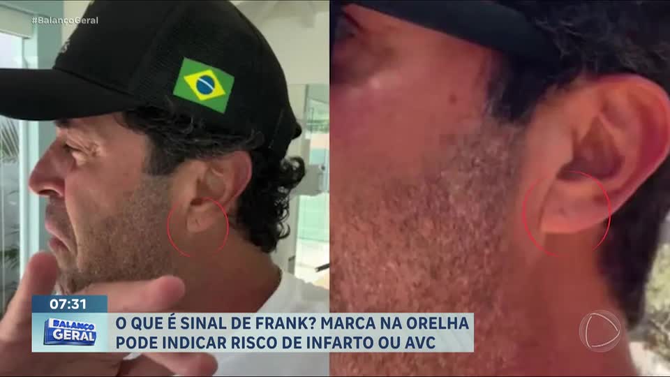Sinal de Frank: marca na orelha pode indicar risco de infarto e AVC