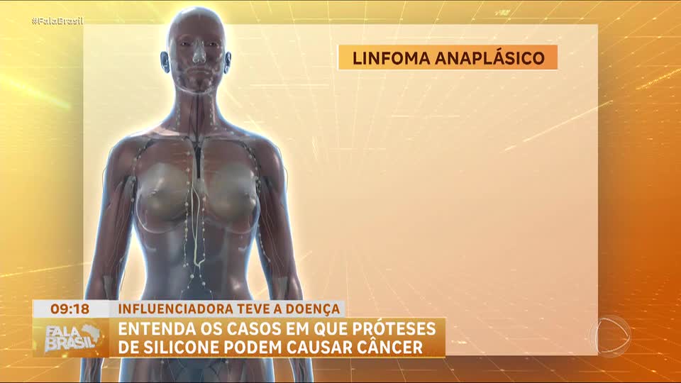 Entenda os casos em que próteses de silicone podem causar câncer