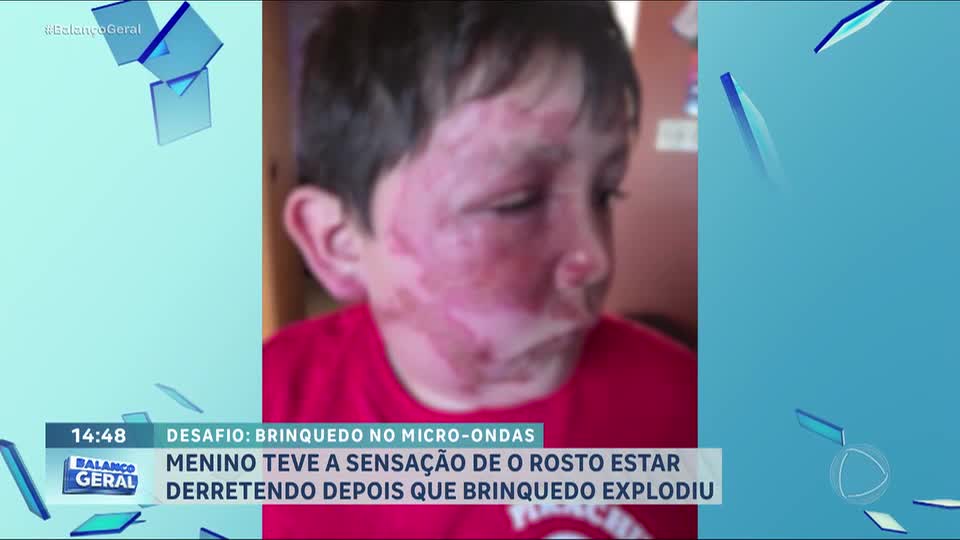 Menino de 9 nove sofre graves queimaduras depois de realizar desafio famoso da internet