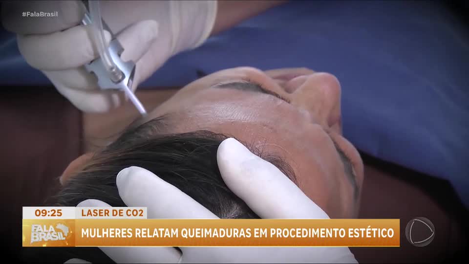 Mulheres relatam complicações após procedimentos com laser de CO2