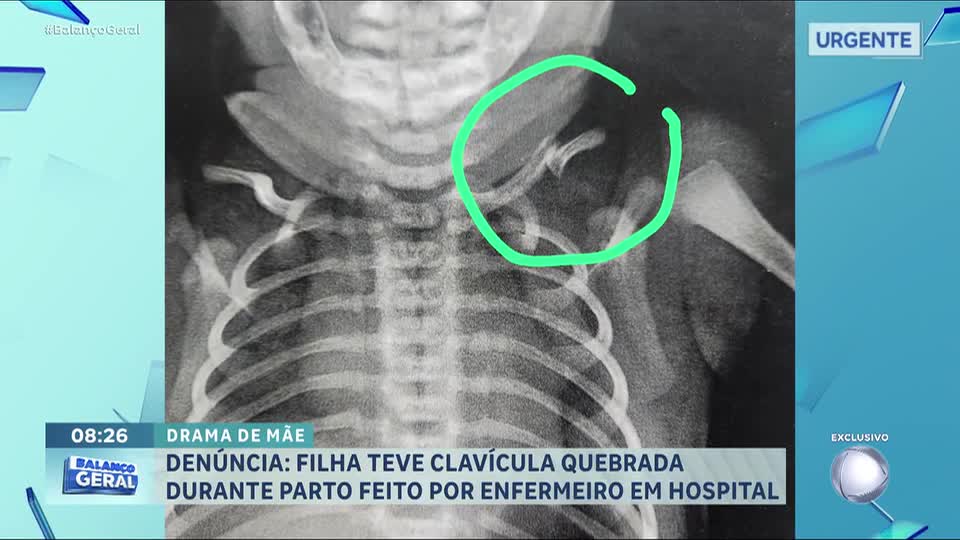 Mãe denuncia que filha teve clavícula quebrada durante parto feito por enfermeiro em Osasco (SP)