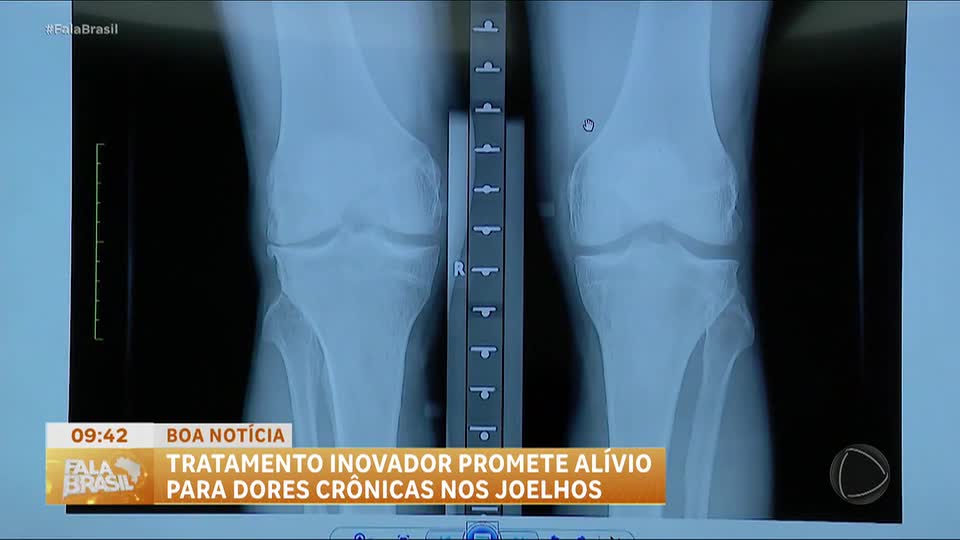 Boa Notícia: Tratamento inovador promete aliviar dores intensas e limitações no joelho