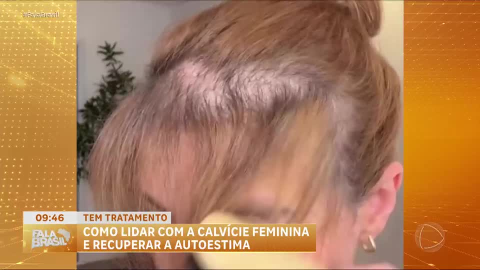 Alopecia feminina: como lidar com a queda dos fios e recuperar a autoestima
