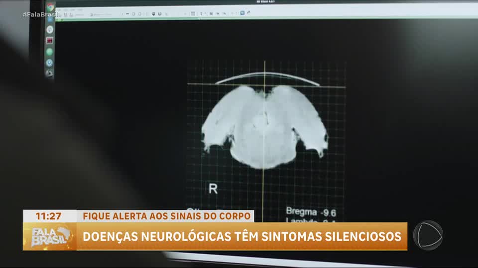 Sintomas que parecem comuns podem esconder doenças neurológicas