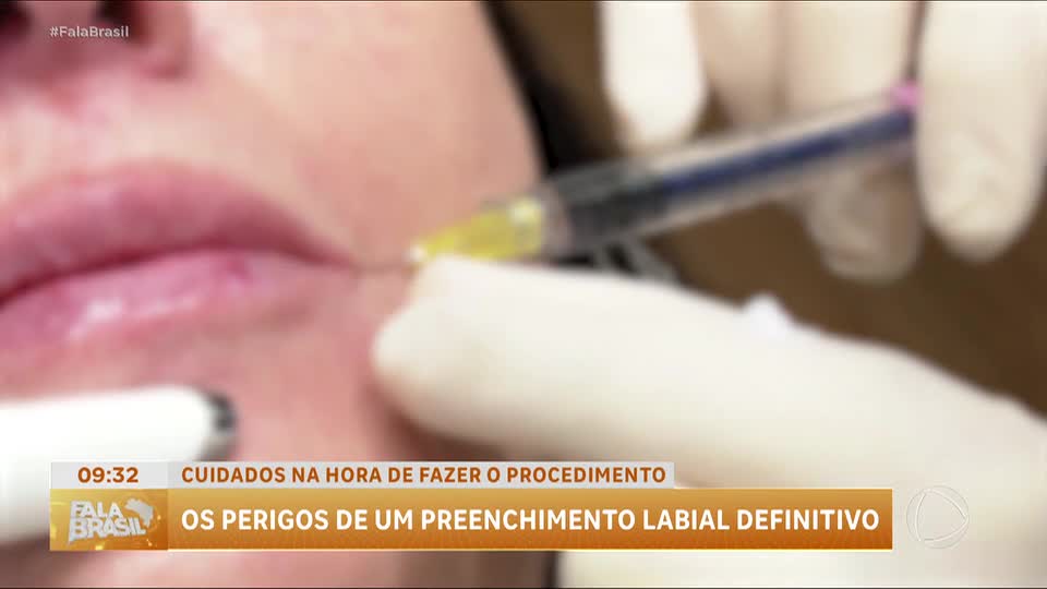 Preenchimento labial: influenciadora alerta sobre riscos e cuidados com o procedimento