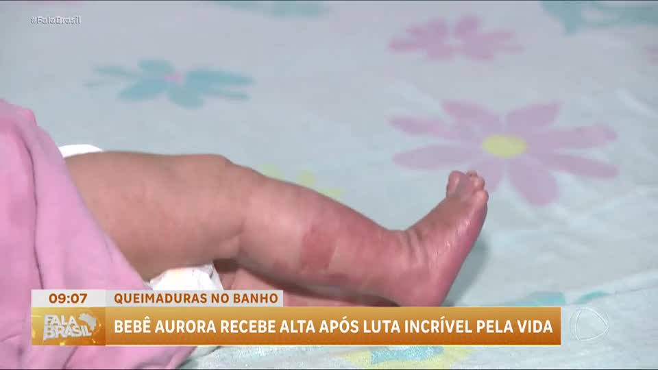 Recém-nascida que teve queimaduras após primeiro banho recebe alta de hospital