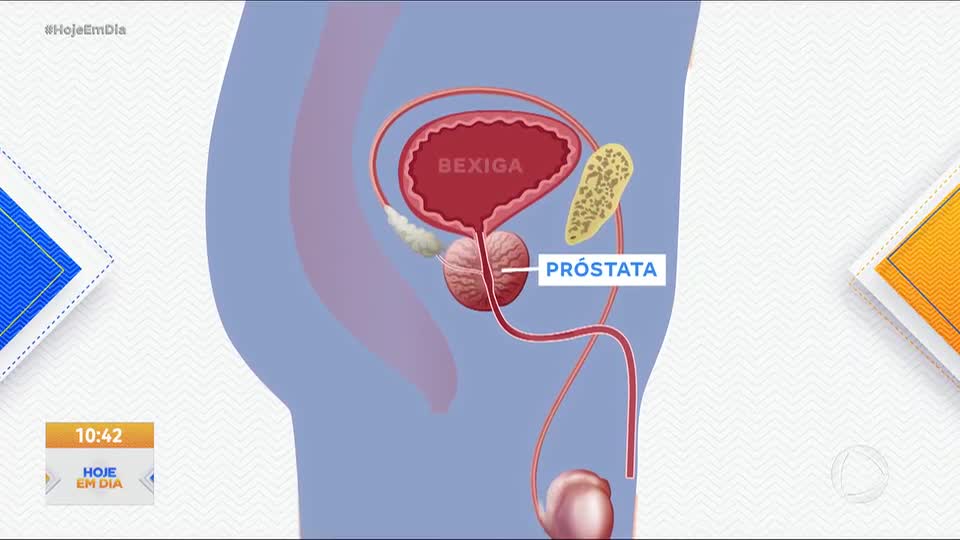 Câncer de próstata: diagnóstico precoce aumenta as chances de cura