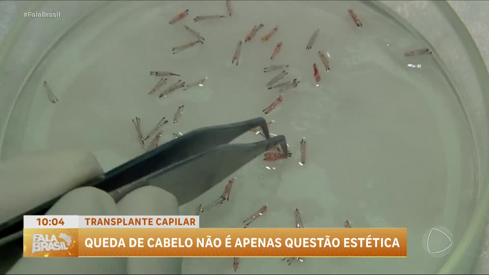Transplante capilar com técnica moderna combate a calvície e reduz cicatrizes