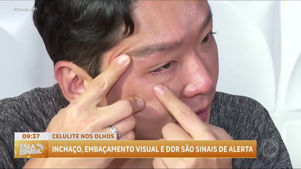 Celulite pós-septal: entenda por que coçar os olhos pode causar graves complicações