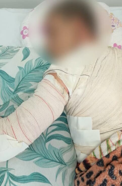 Jovem fica gravemente ferido ao ser atacado com água quente pelo ex-cunhado na Baixada Fluminense