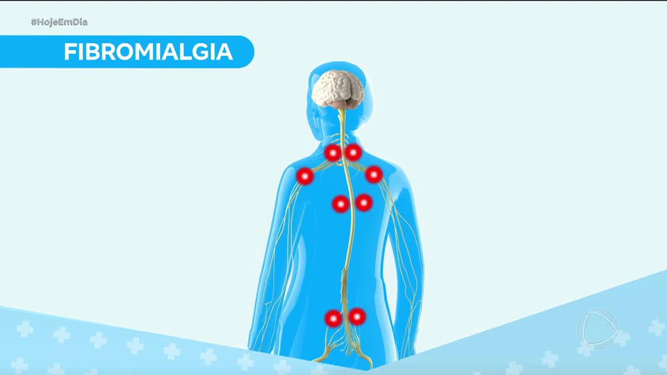 Você e o Doutor: Saiba mais sobre a fibromialgia, síndrome que atinge milhões de brasileiros
