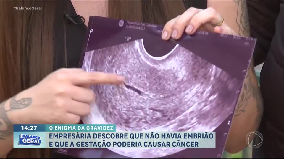 Empresária descobre gravidez molar, condição rara que pode evoluir para câncer