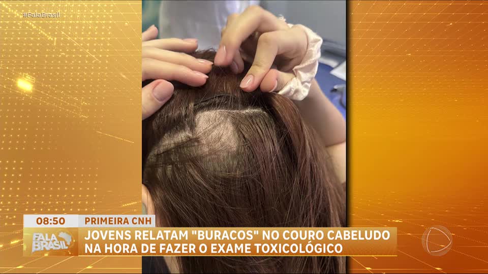 Exame toxicológico da CNH: jovens relatam buracos no couro cabeludo