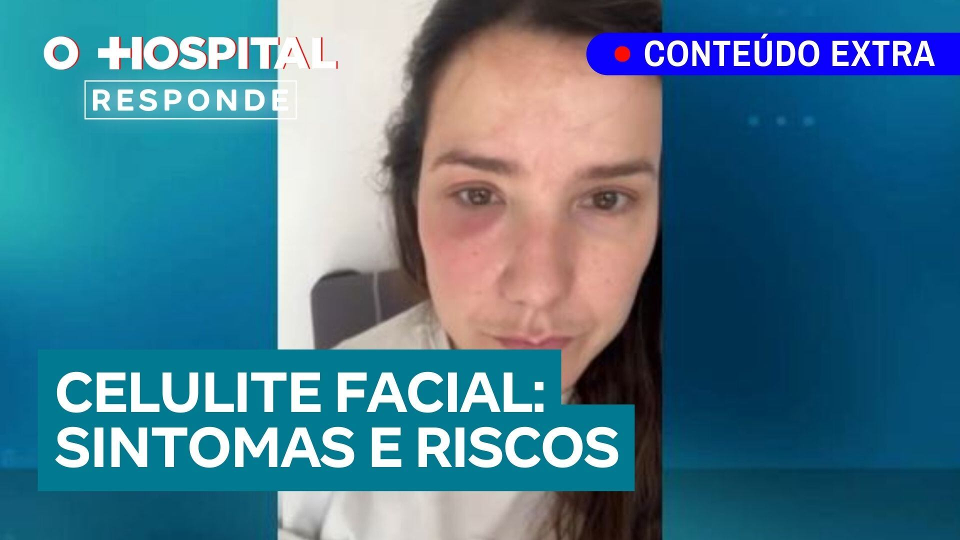 Celulite facial: sintomas, riscos e tratamento | O Hospital Responde