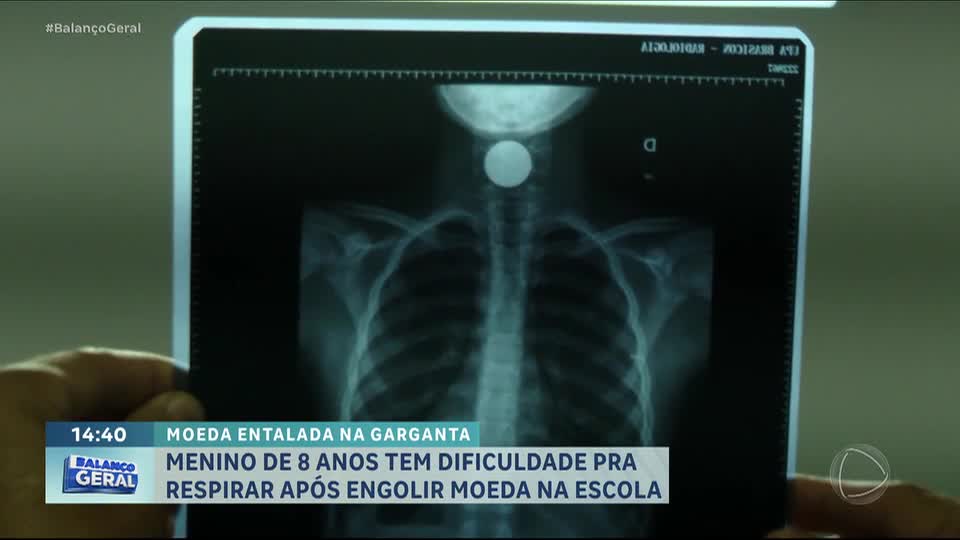 Menino de 8 anos engole moeda na escola, passa mal e é internado em hospital em Goiás