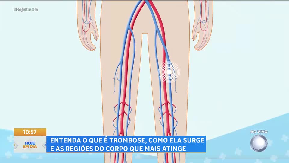 Você e o Doutor: Entenda o que é a trombose, como ela surge e as regiões do corpo que mais atinge