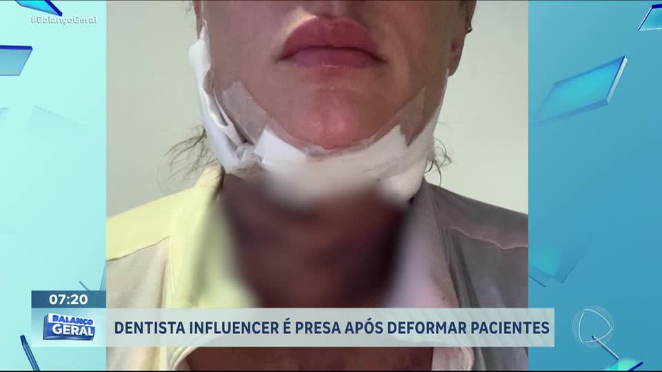 Dentista influenciadora é presa após deformar pacientes em procedimentos estéticos