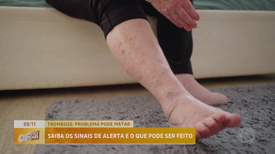 Trombose: saiba os sinais de alerta e o que pode ser feito