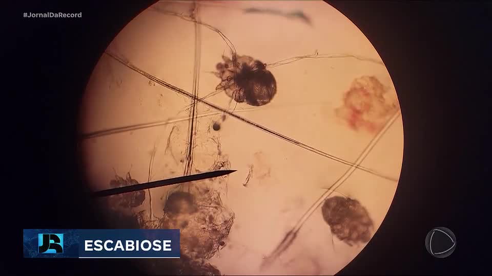 Quase 9 mil crianças estão sem aulas em Lagoa Santa (MG) por causa de surto de sarna humana