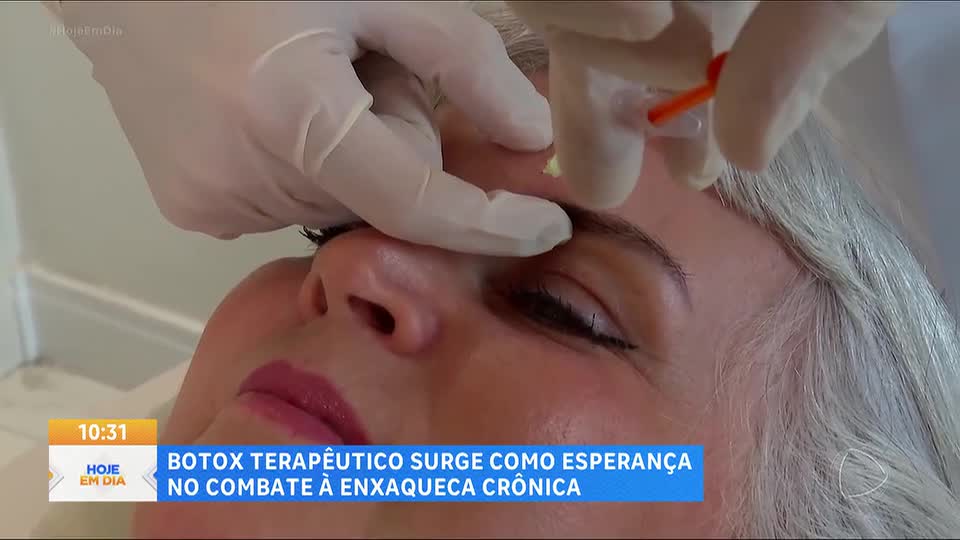 Botox terapêutico surge como alternativa para tratar enxaqueca