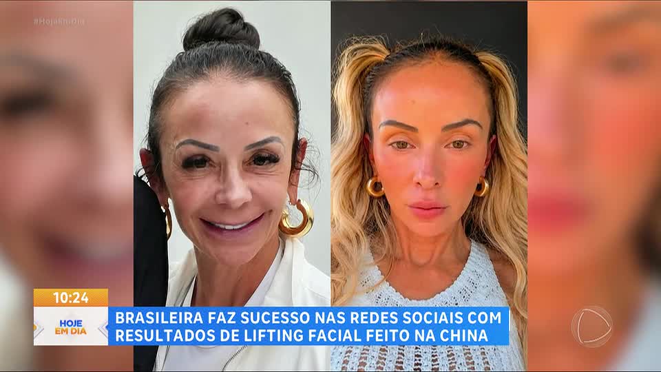 Lifting facial cresce no Brasil e atrai pessoas em busca de resultados naturais