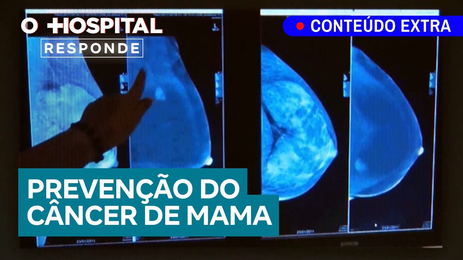 Câncer de mama: informação é prevenção | O Hospital Responde