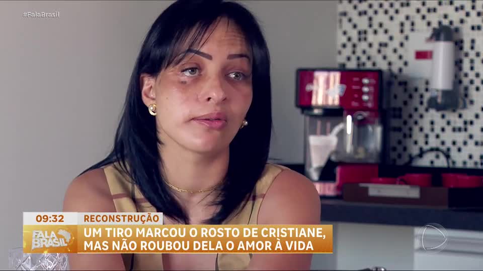 Mulher faz cirurgias de reconstrução facial após violência doméstica