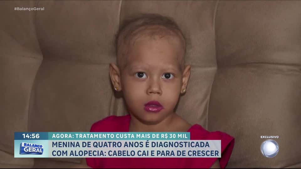Menina de 4 anos enfrenta alopecia areata universal e família tenta pagar tratamento