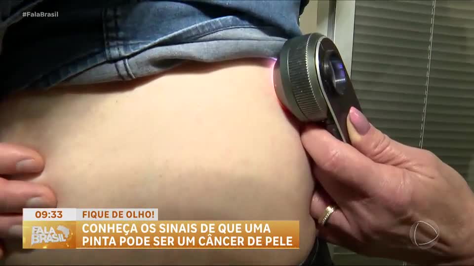 Pintas suspeitas: saiba como identificar sinais de câncer de pele