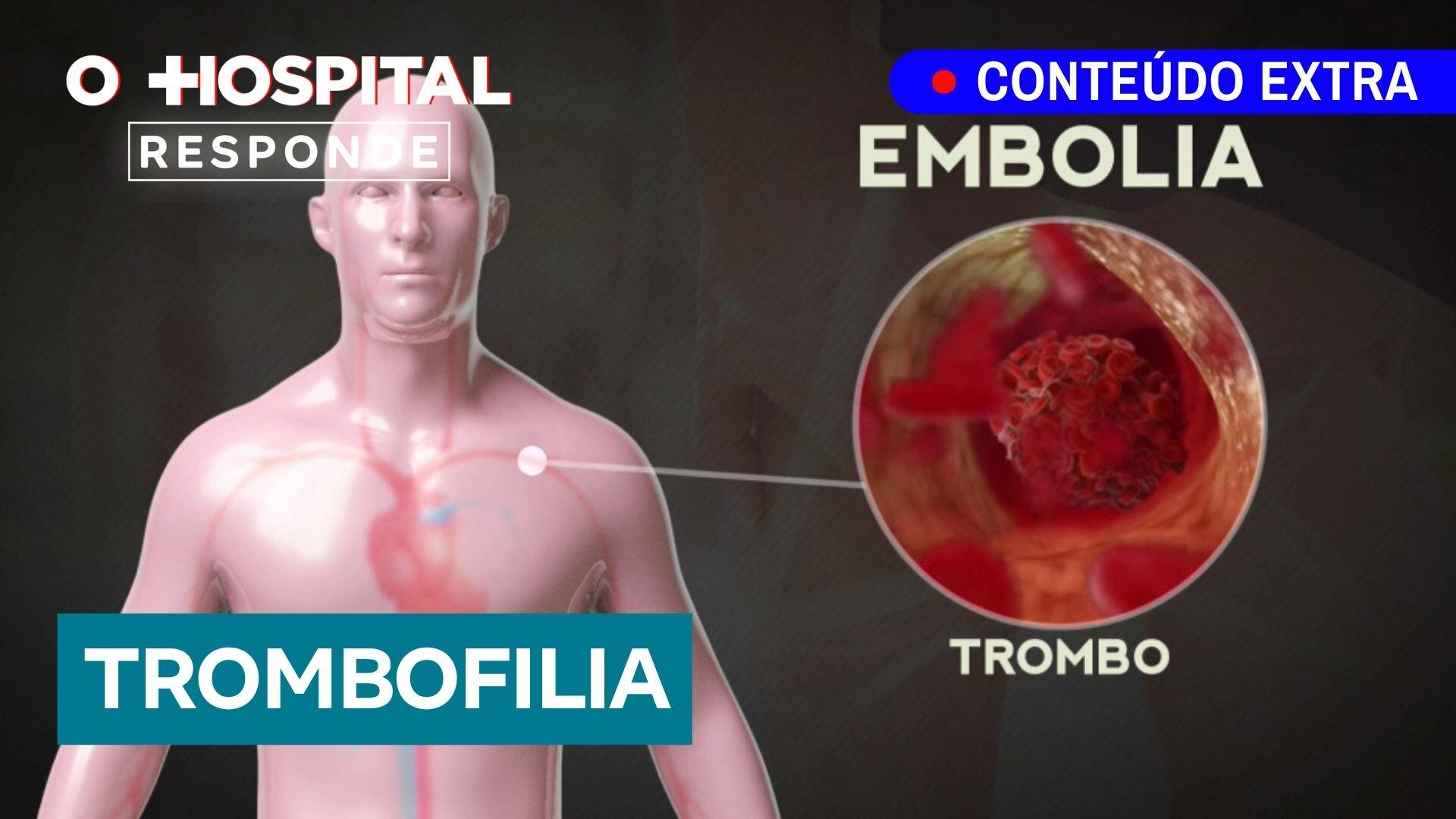 Trombofilia: tudo o que você precisa saber | O Hospital Responde