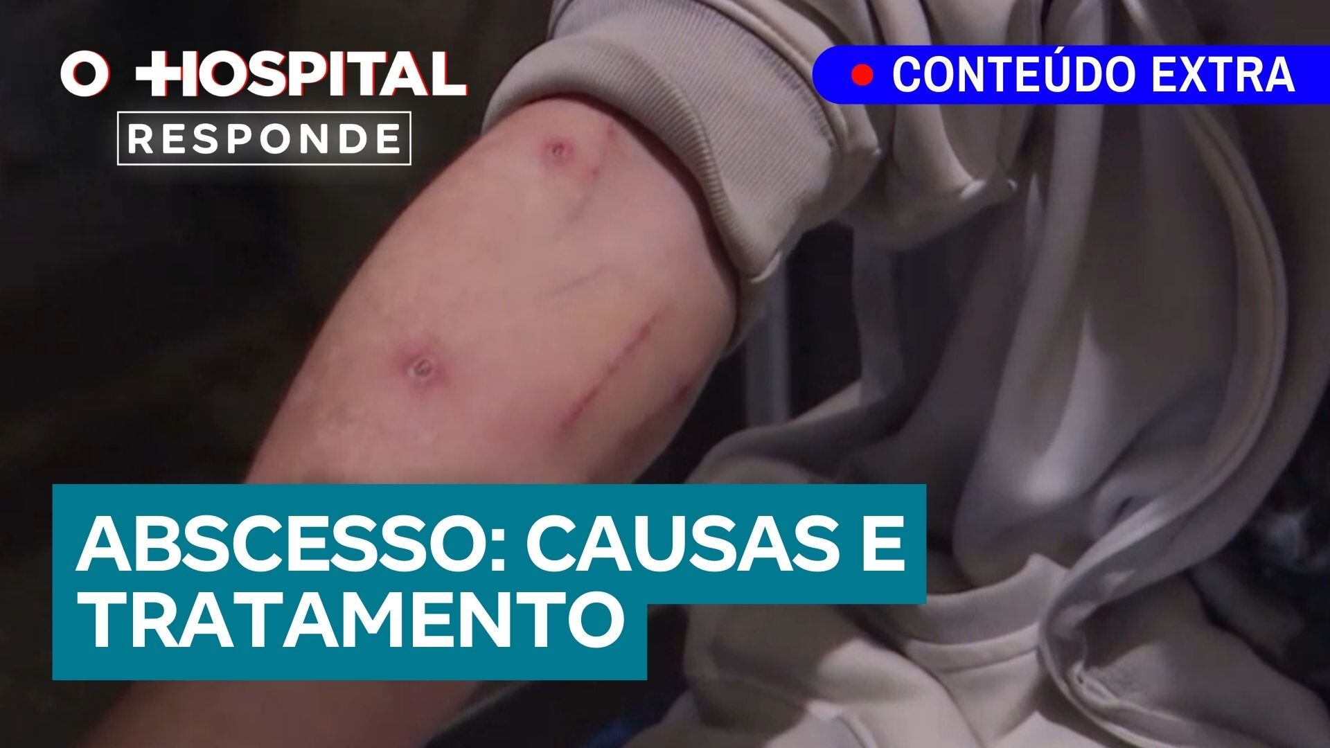 Abscesso: o que é, causas e tratamento | O Hospital Responde