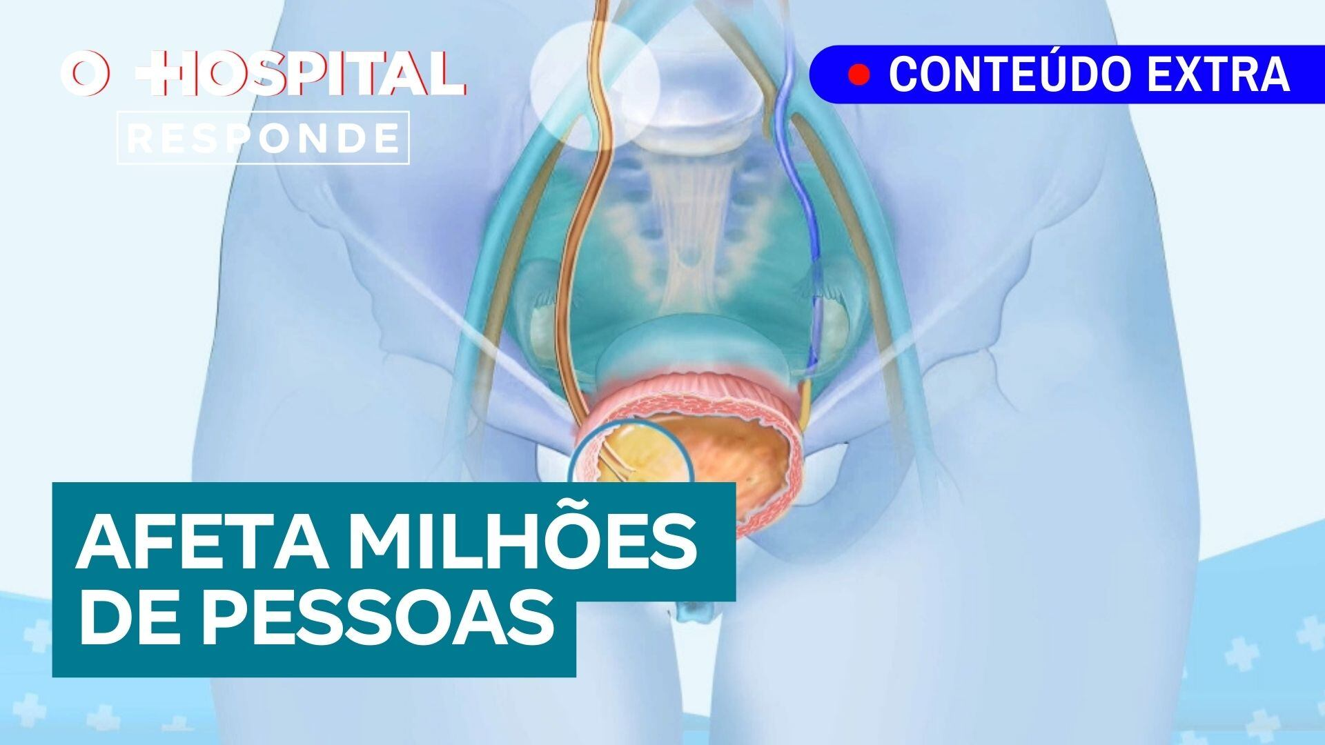 Pedras nos rins: tudo o que você precisa saber | O Hospital Responde