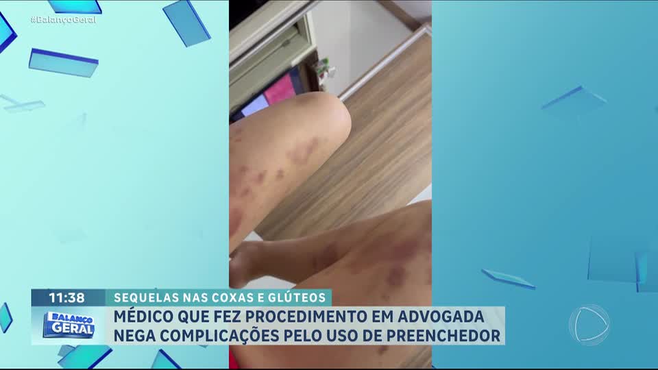 Advogada sofre sequelas após preenchimento com PMMA