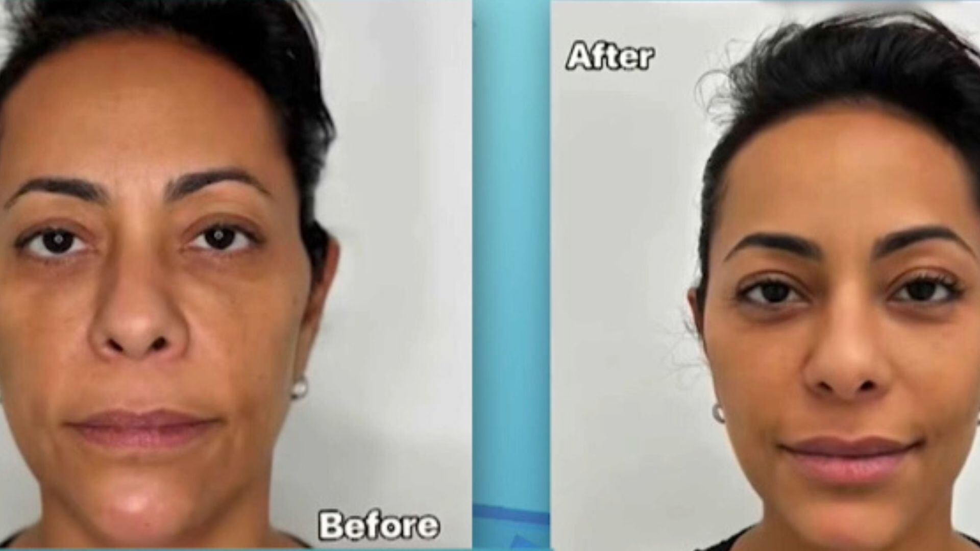 Samantha Schmütz contrata médico das Kardashians para fazer transformação no rosto