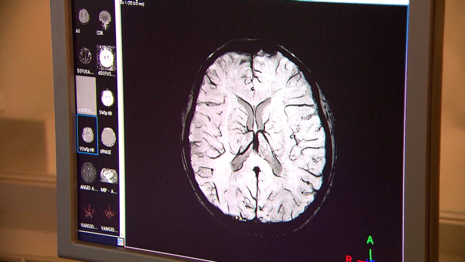 Imunizante pode reduzir chance de demência em até 20%