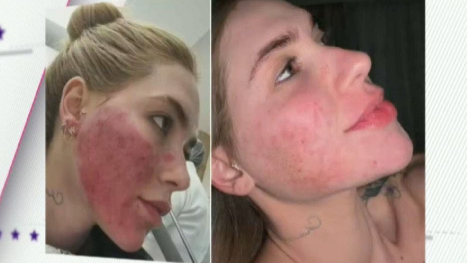 Virginia Fonseca assusta fãs ao mostrar resultado de procedimento estético no rosto