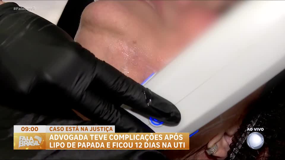 Advogada sofre complicações após lipo de papada no Rio; dentista é denunciada