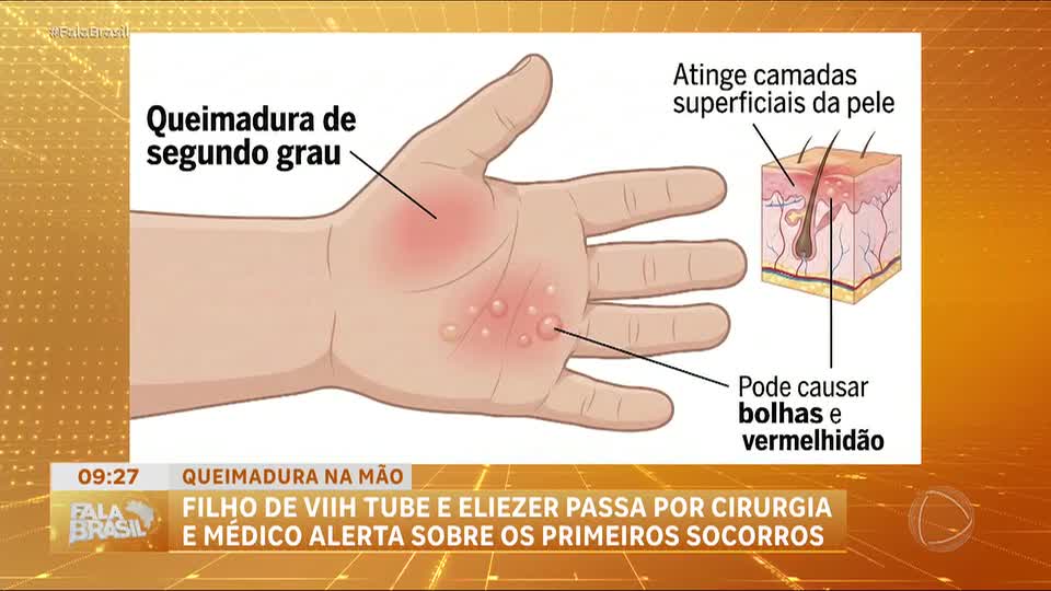 Filho de Viih Tube e Eliezer passa por cirurgia após sofrer queimadura de segundo grau